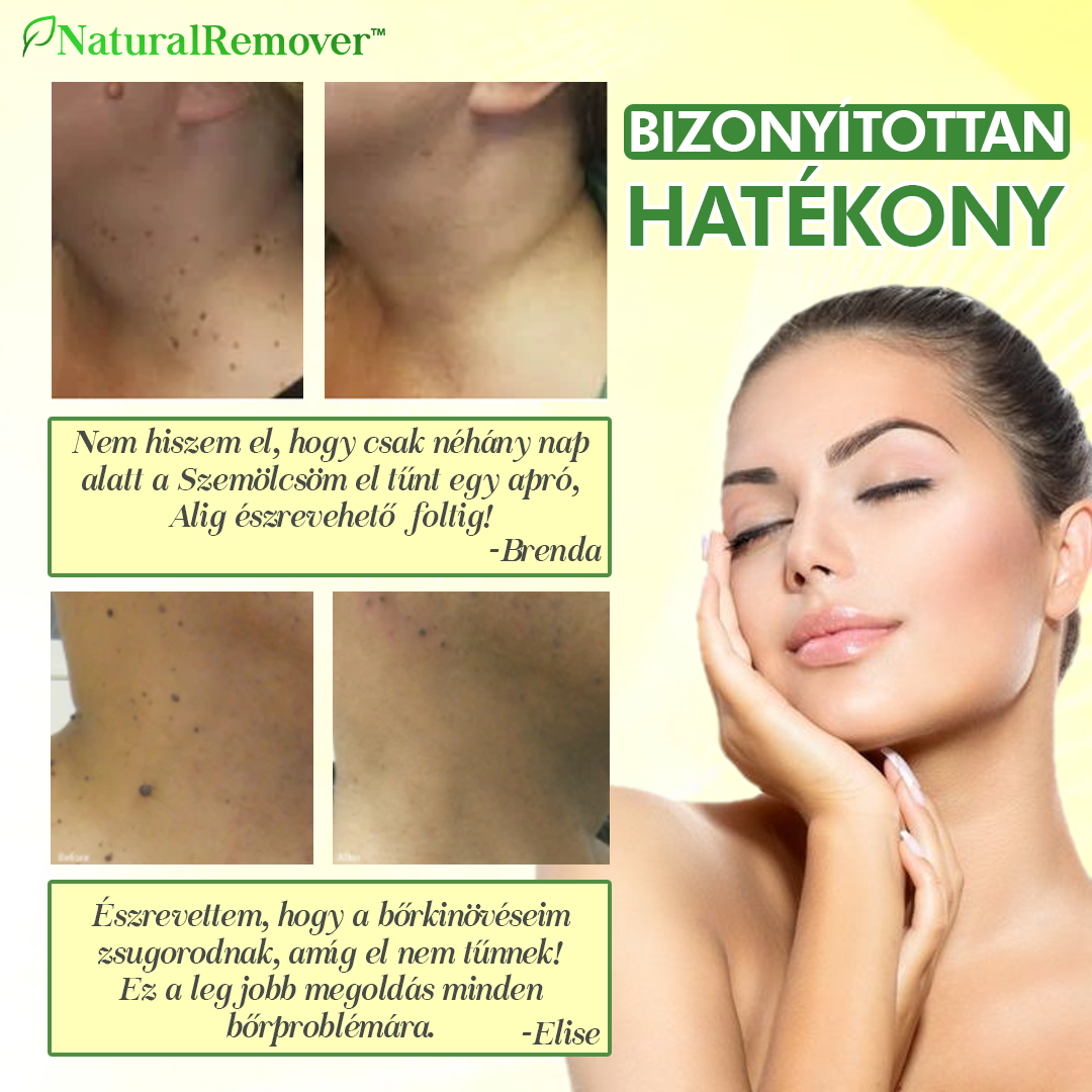 NaturalRemover™ Bőrkinövés Eltávolító